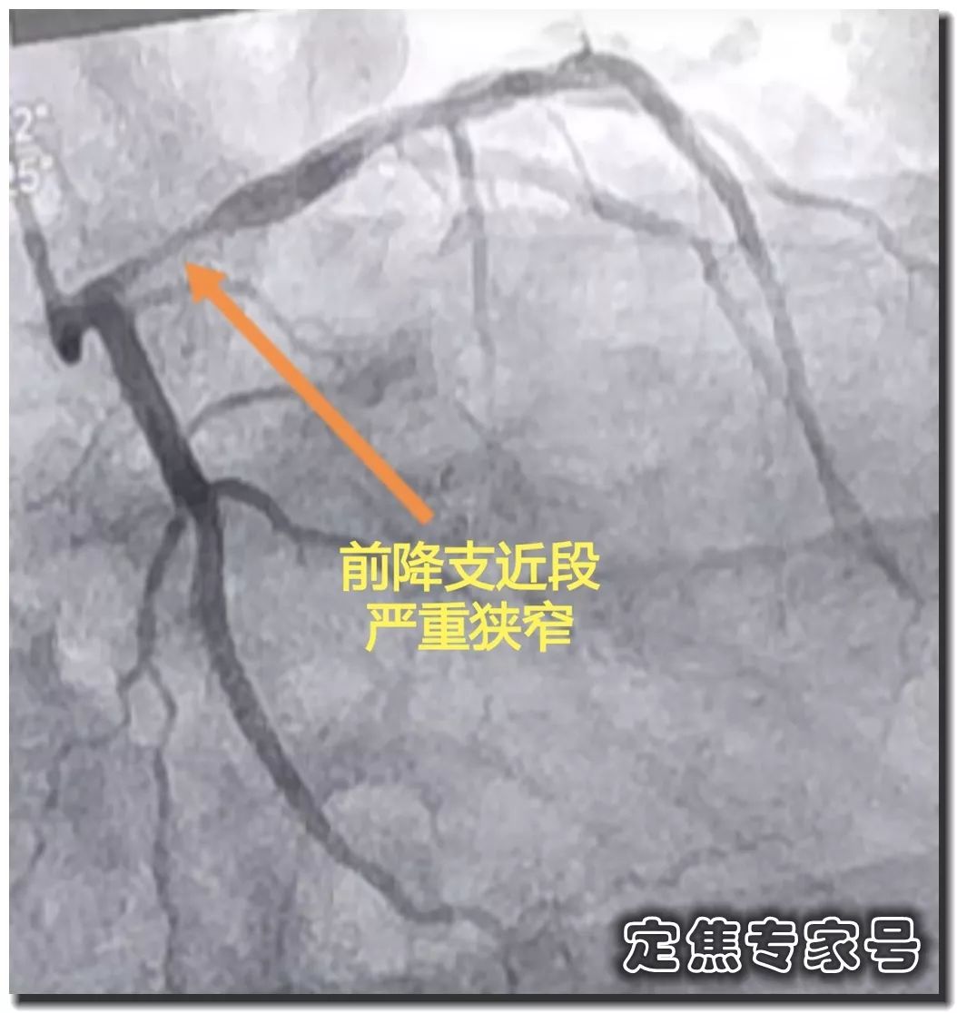 从"上火"到心肌死亡仅5天！速效救心丸和硝酸甘油，谁才是救命药