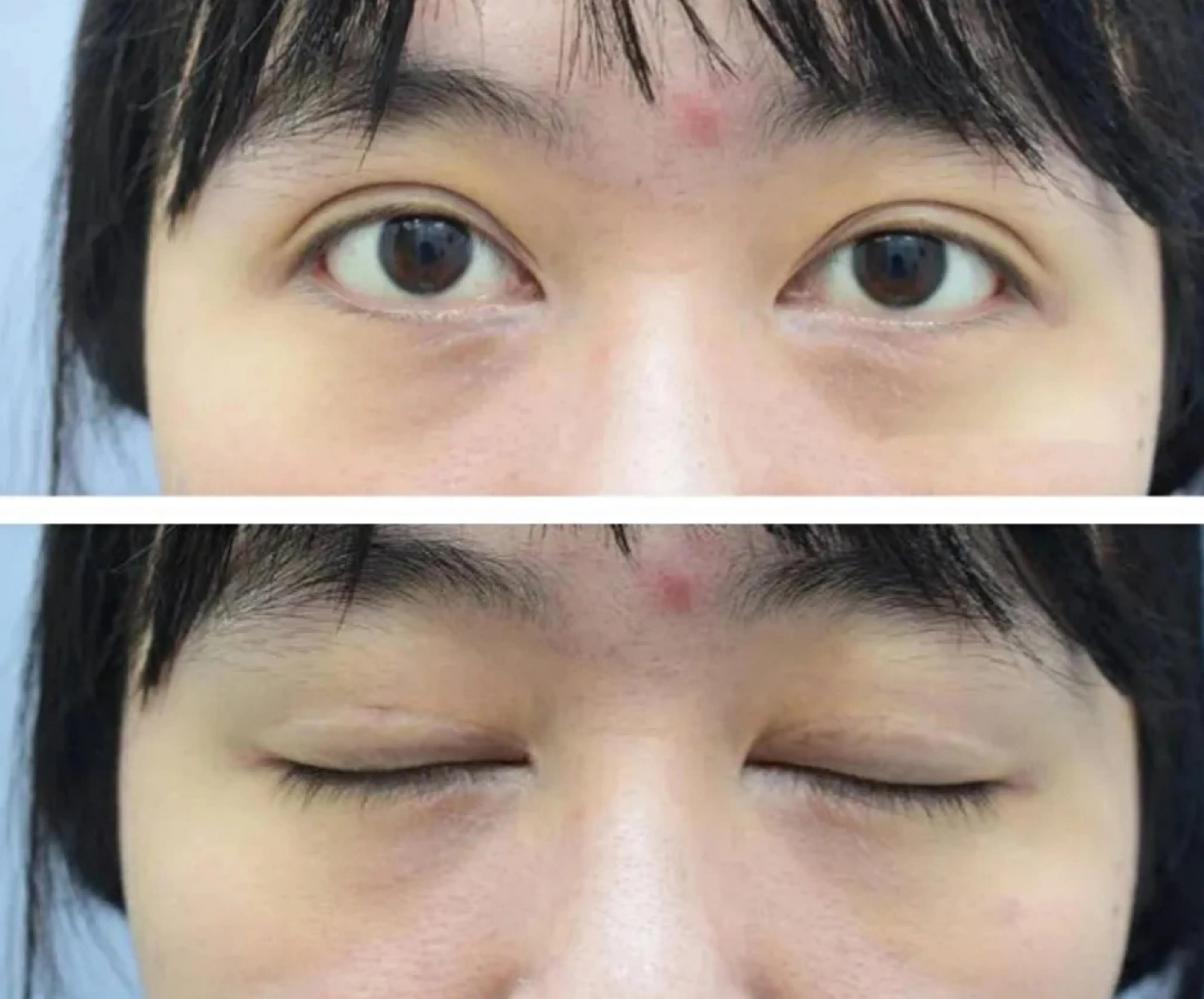 It looks fake after cutting double eyelids. Why is that?How to avoid false widening after double