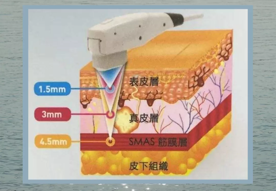 入门级医美项目指南!美容院不告诉你的,这篇全都有