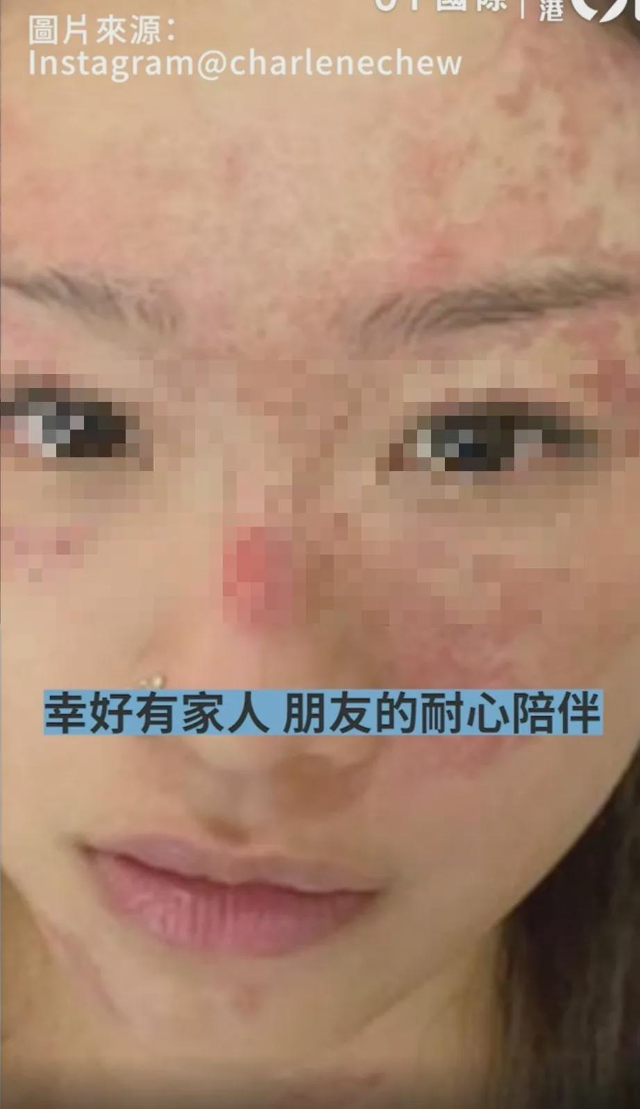 澳洲华人美女脸都炸烂了，厨房里这个行为要命，每个人都会犯