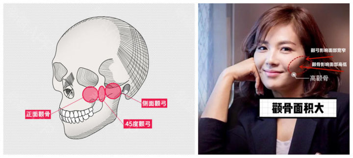 Cheekbones are the key to bone beauty; Dr. Fan Fang talks about the ...