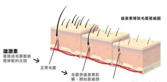 一文读懂M型脱发该怎么治疗
