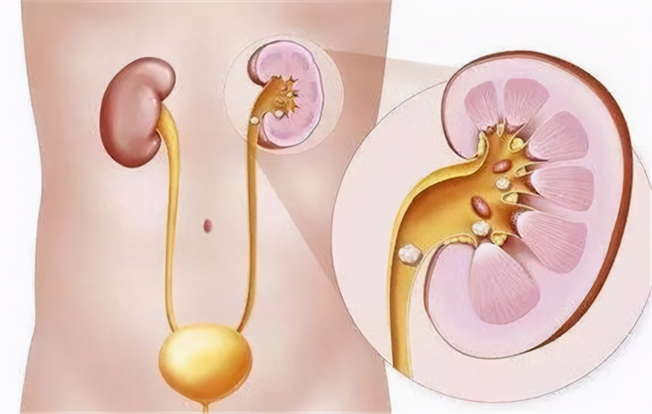 Prostate Calcification How is prostate calcification caused?What is the specific performance ...