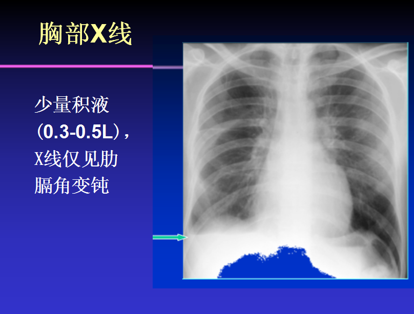 治疗胸水需要多久？首先你需要了解影响治疗的这些因素