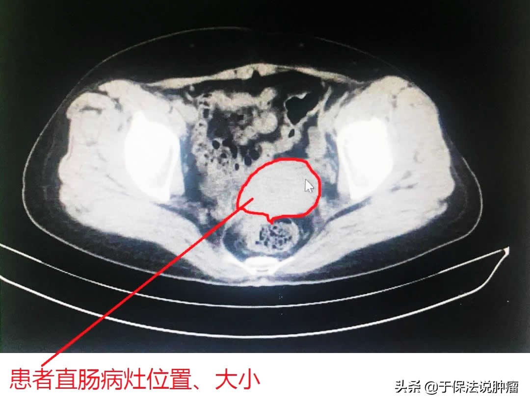 直肠间质瘤术后复发，经缓释库超微创治疗，现存活已超5年