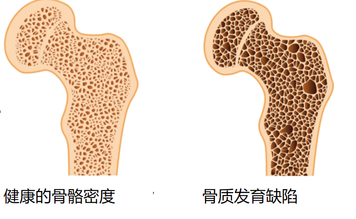 预防骨质疏松，不只补钙这么简单