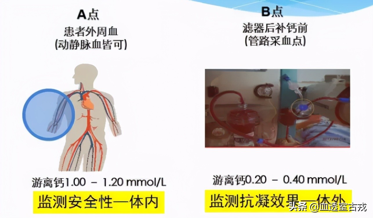 CRRT治疗中，分段枸橼酸钠体外抗凝效果如何？怎么用？
