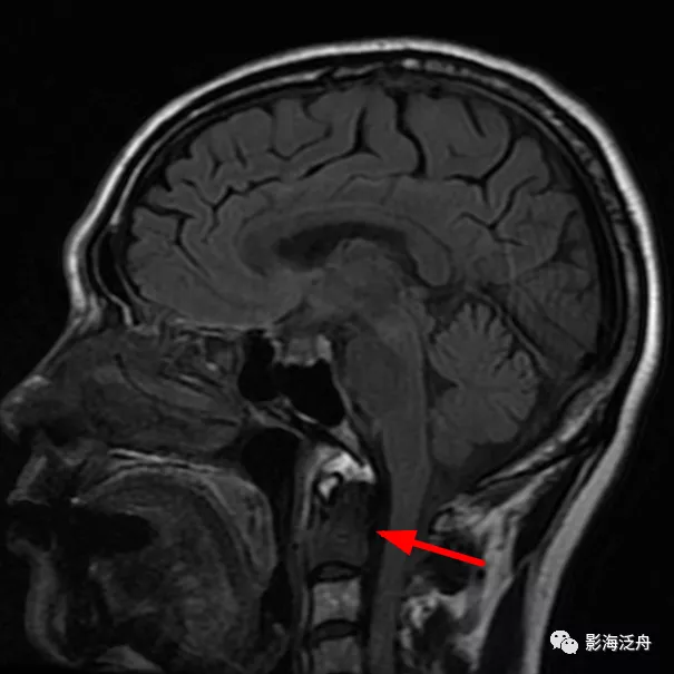 超级干货--颅脑MR中易漏诊点全面总结