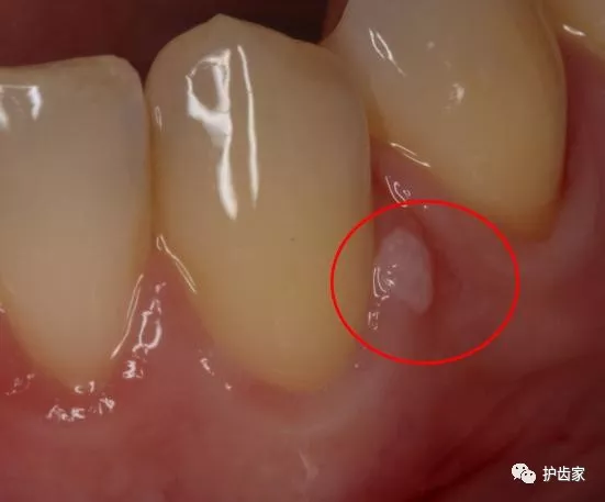 牙龈上长脓包，挤掉后还反复长出，怎么回事？