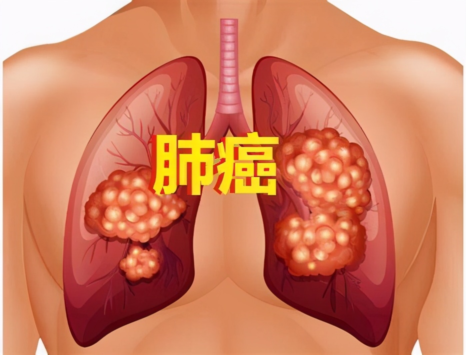 奥希替尼 泰瑞沙在中国获批：辅助治疗早期EGFR突变肺癌