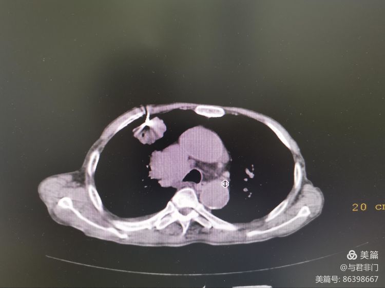 菏澤市二院腫瘤科成功開展在CT引導下經皮肺穿刺活檢術