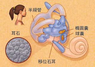 什么？耳朵也有石头！耳石症，一种极易被误诊的眩晕