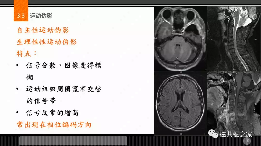 磁共振常见伪影及策略