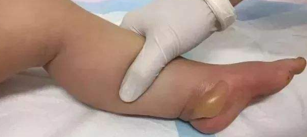 孩子手脚凉，不靠谱奶奶用“热水袋”捂给孩子捂脚，结局痛心
