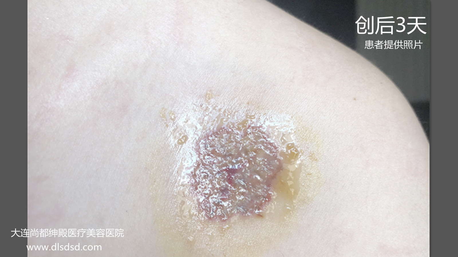 Can a black tattoo be completely washed off? It will look like a few