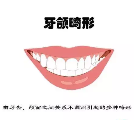 什么牙需要矫正呢？