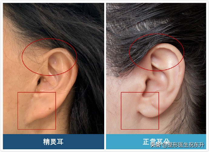 做大拉皮手术，我的耳朵“变形”了？