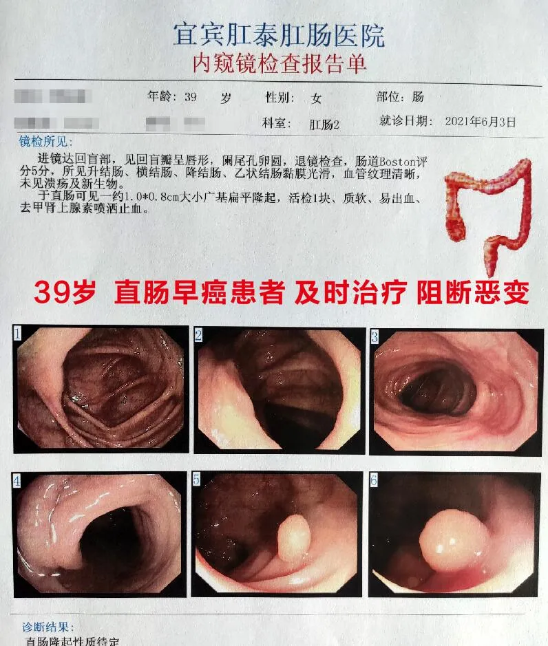 肛肠科医生建议 39岁痔疮患者做肠镜 查出直肠早期肿瘤 资讯咖