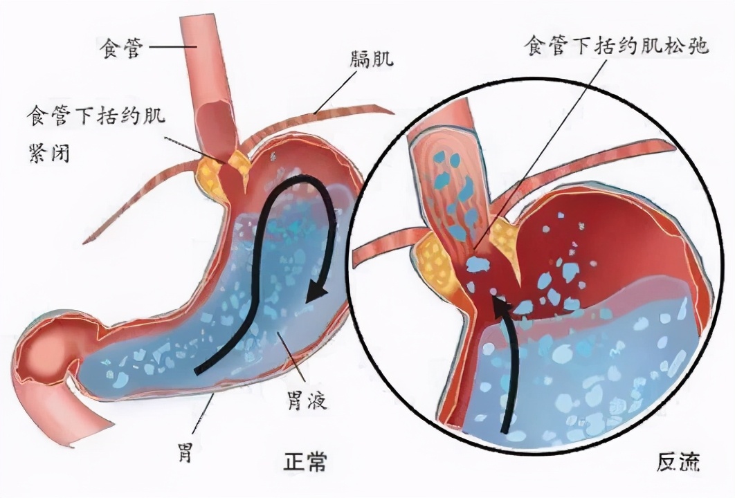 《门诊故事》明明患了咽喉炎，医生却给我开胃苏颗粒？