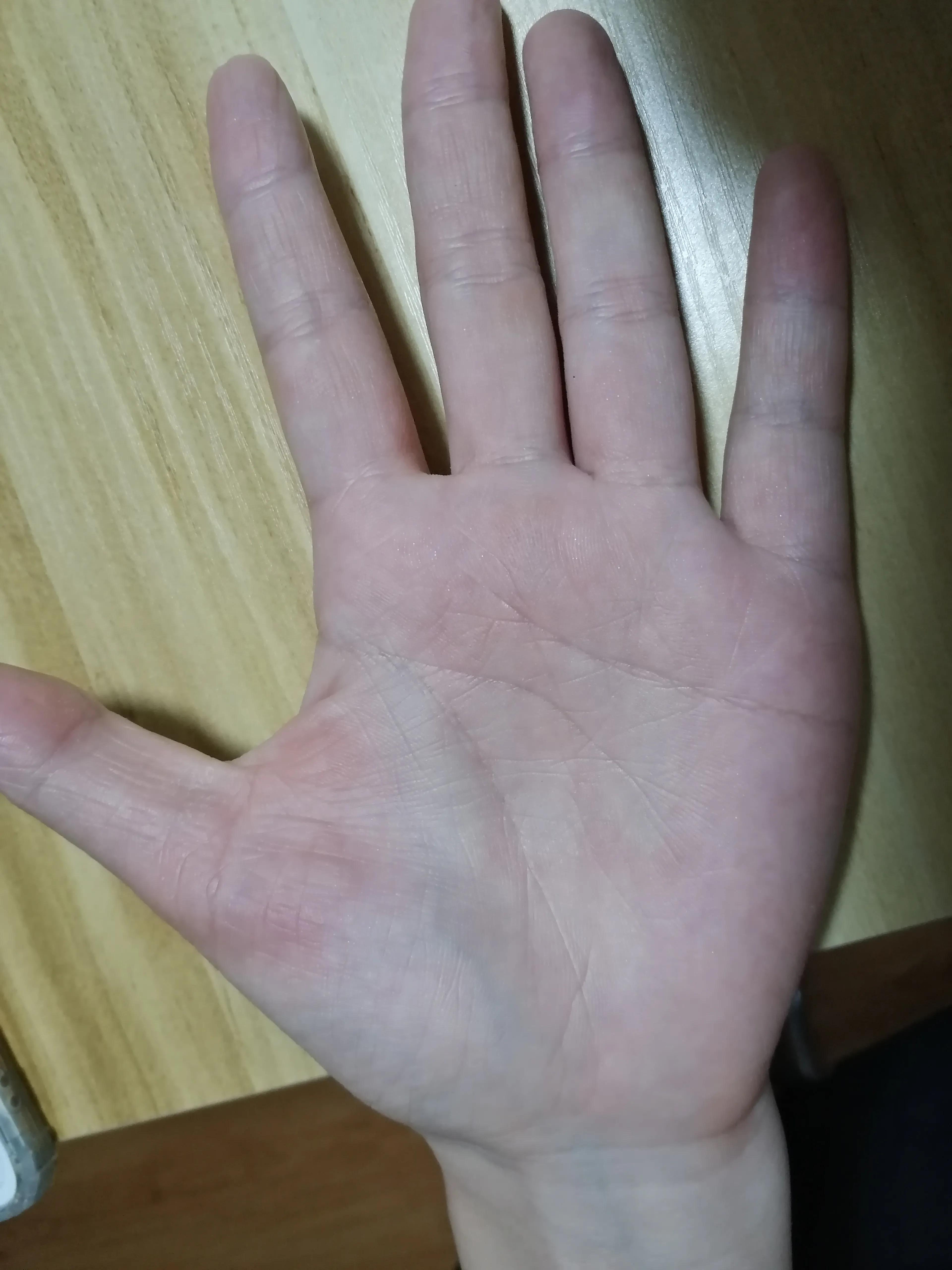 Hand eczema treatment with Chinese medicine iNEWS