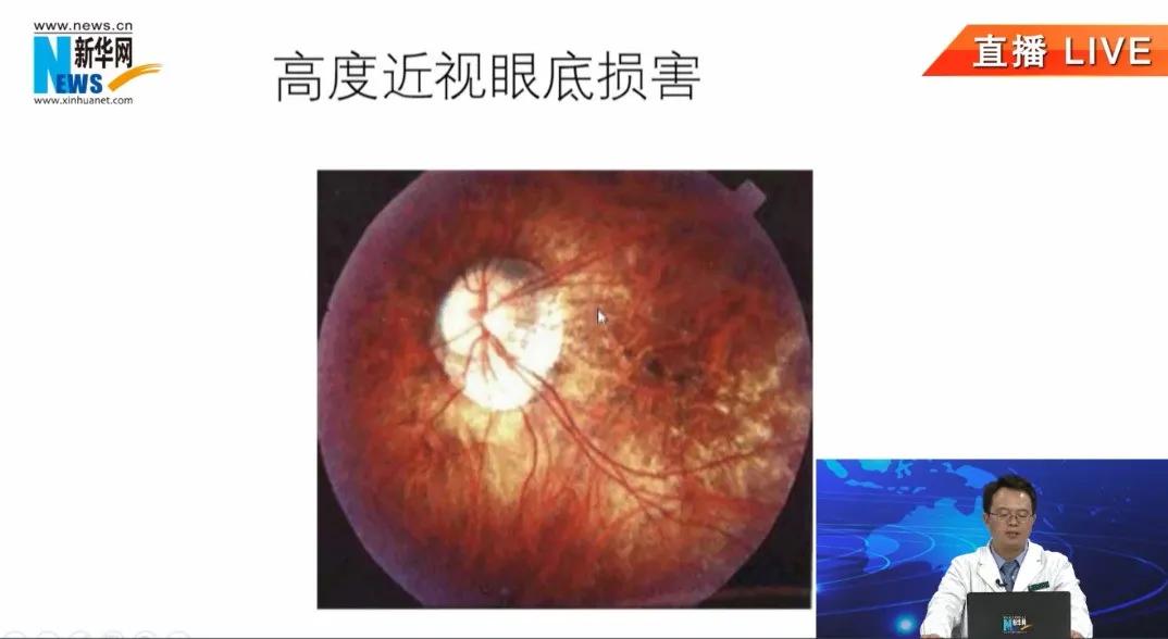 My child is nearsighted, what should parents do? iNEWS