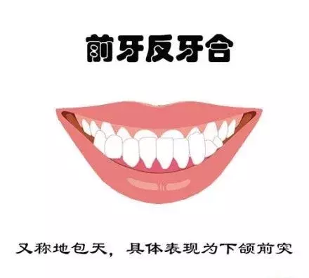 什么牙需要矫正呢？