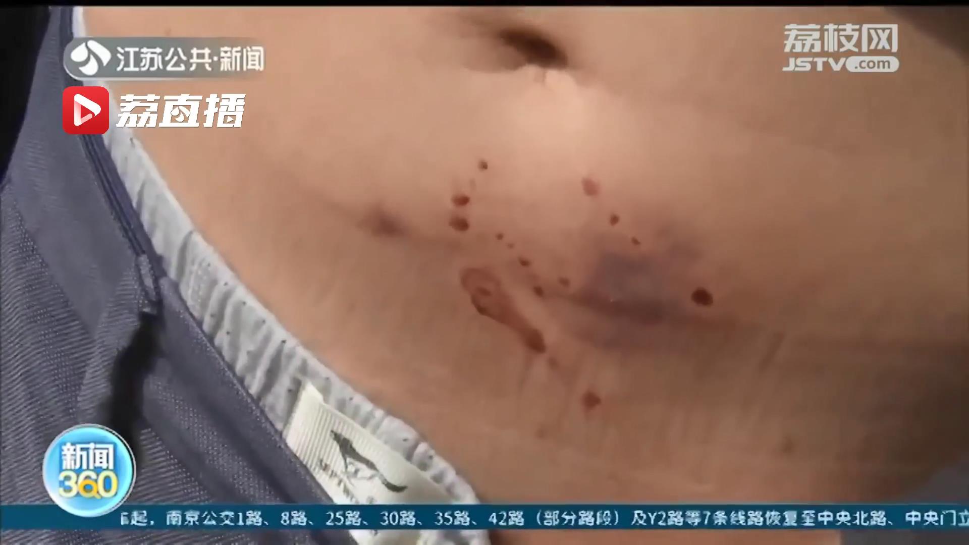 天热当心动物烦躁！南通一恶犬接连咬伤20多人 有人被咬伤肚子