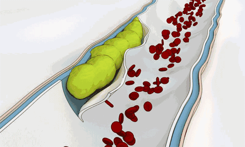 血管裡有垃圾，定期輸液通血管？ 醫生：這些做法坑你沒商量�