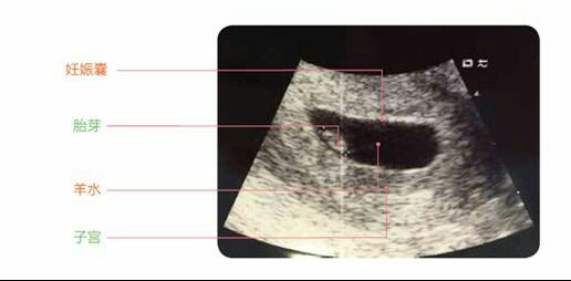 孕早期b超图解,准妈妈需知的7个指标