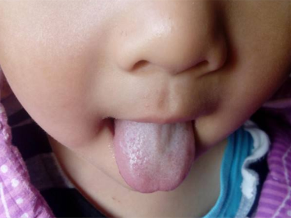 宝宝“舌苔发白”的原因，以及对应的处理方式，别耽误了
