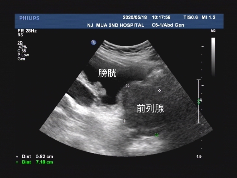 坦索罗辛在前列腺增生中如何应用？这几点你要知道