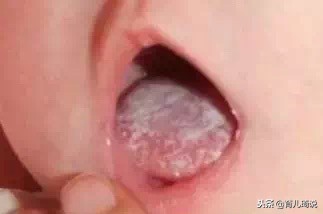 宝宝舌头发白是生病了吗？如果宝宝舌头发白，一定要警惕这种病
