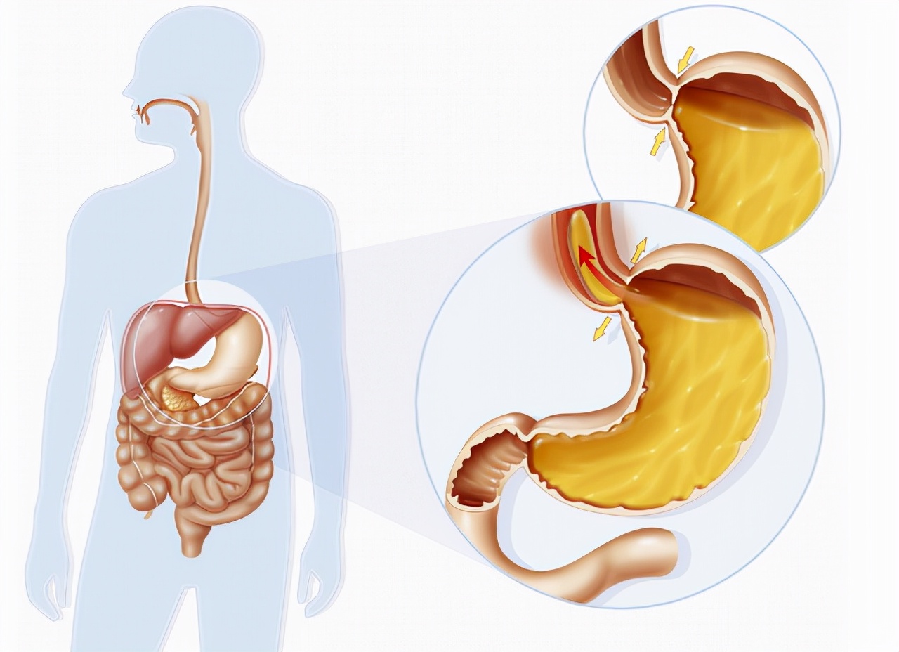 “胃食管反流”食用什么好？医生：这3种食物或可以减缓反流