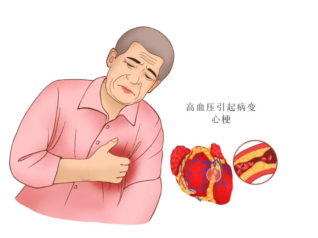 心梗不一定是胸痛。医生提醒：出现这10个症状，做3项检查才安全 - 知乎