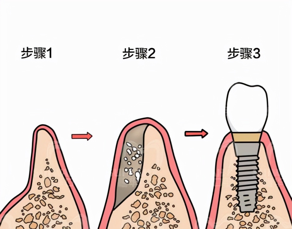 Why do I need to add bone meal and periosteum to dental implants? iNEWS