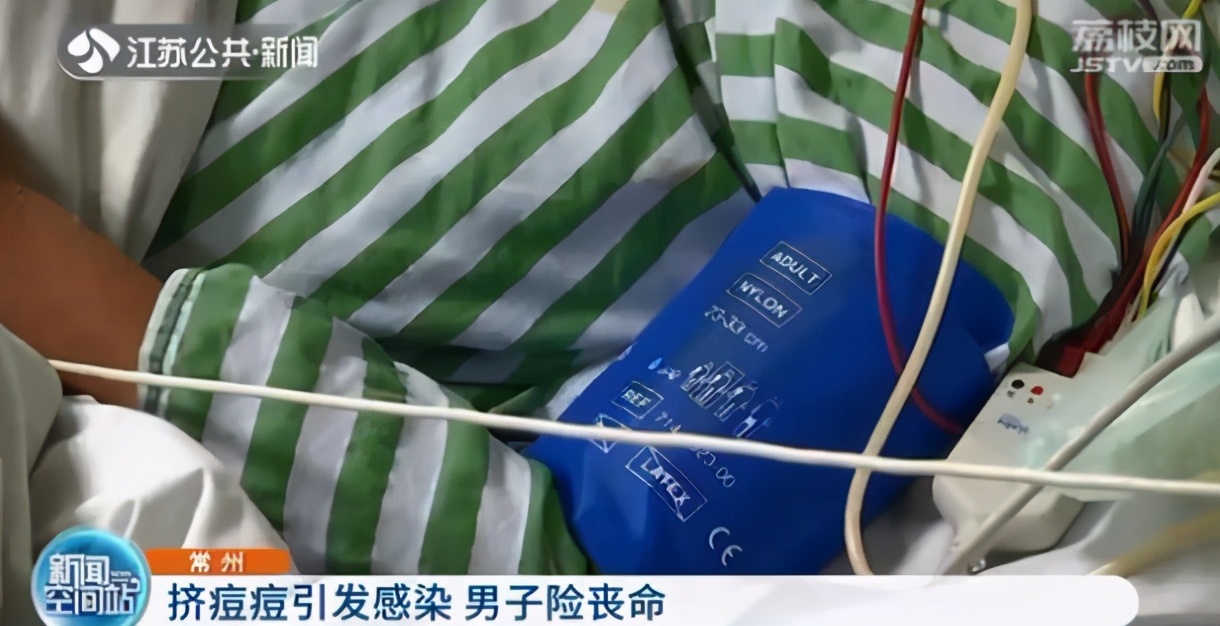 男子挤痘痘引发肺部严重感染 抢救时甚至用上“人工肺”ECMO