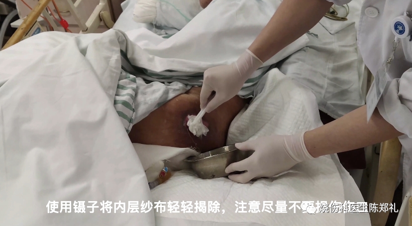 褥疮系列3：褥疮、窦道换药过程视频+图解
