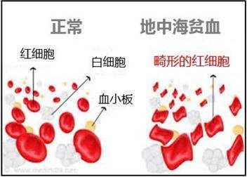 可恶的地中海贫血，是怎么回事？有何治疗新进展？