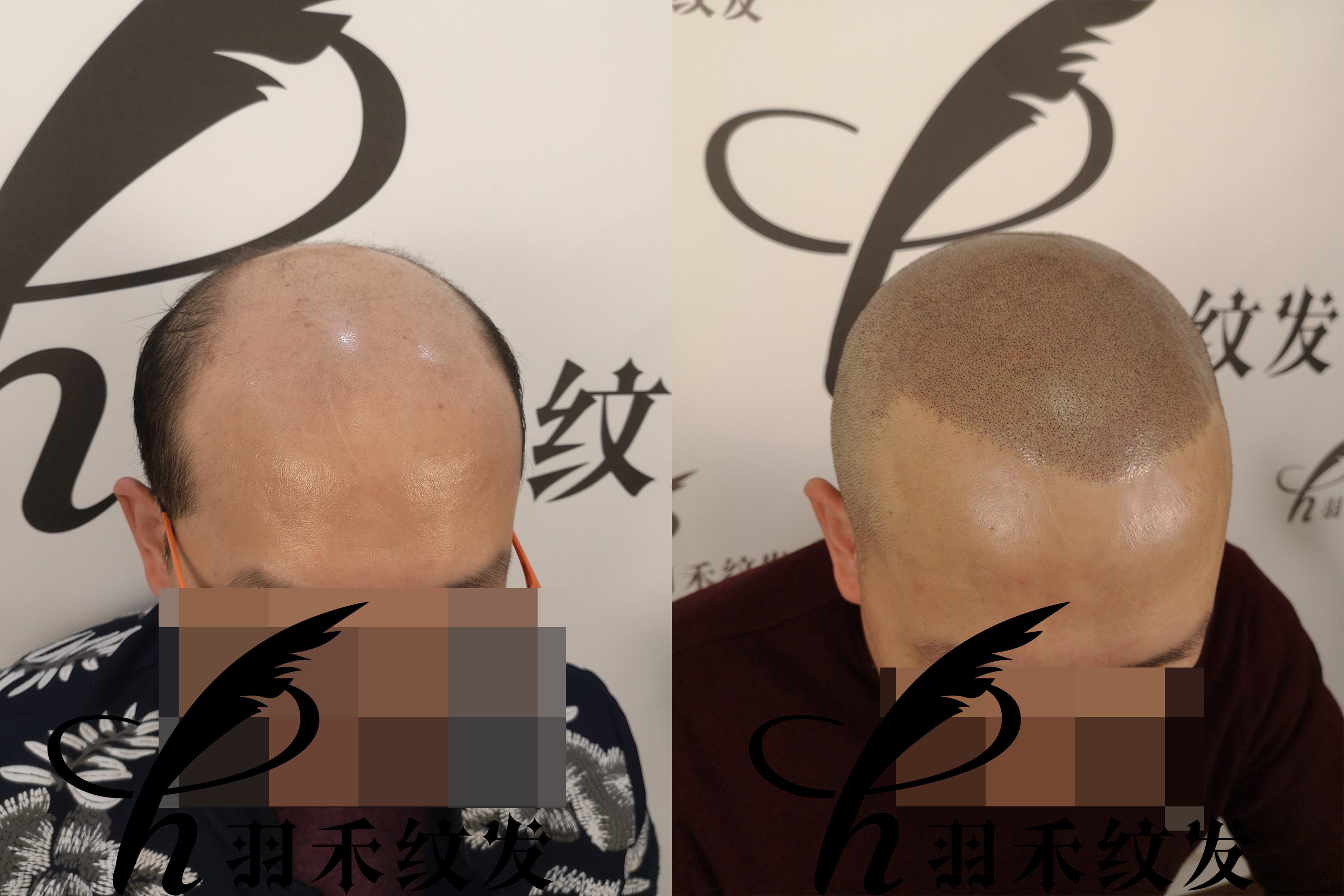 纹发后还能戴假发吗？