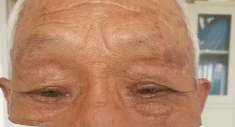科普——眼整形手术是个什么手术?(多图)