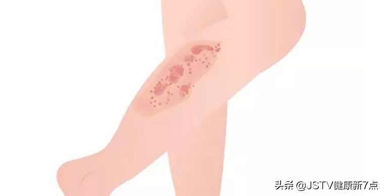 四物汤、四君子汤，看中医药专家怎么用传统处方治疗慢性皮肤病