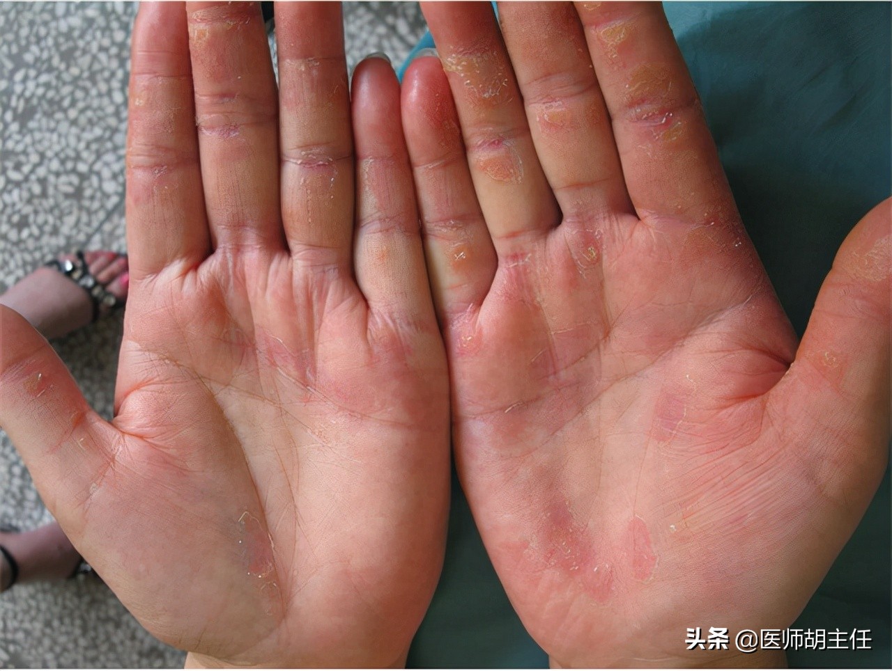 Dishwashing liquid is "harmful". It not only hurts hands but also