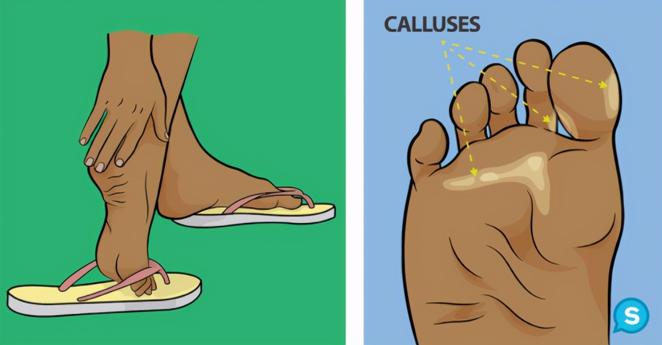 Foot pain without knowing the cause?6 kinds of "most hurting feet