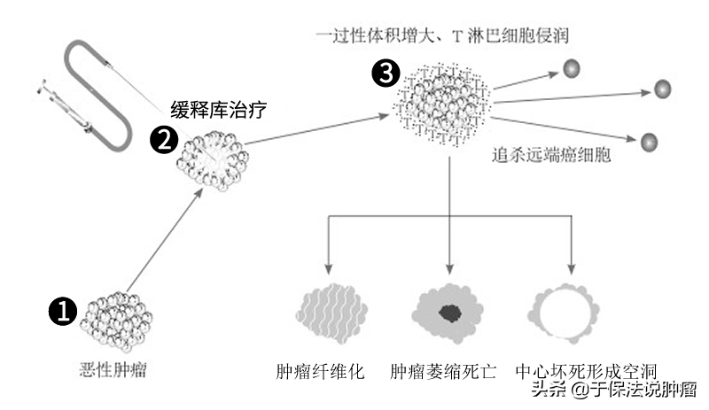 75岁后背疼痛确诊肺癌，拒绝手术化疗，经缓释库治疗改善明显