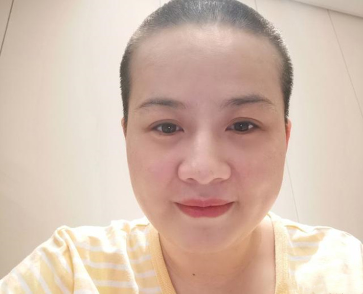 岳云鹏老婆自曝需手术，"秃头"造型令人