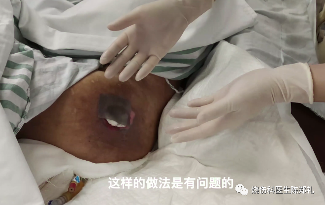 褥疮系列3：褥疮、窦道换药过程视频+图解