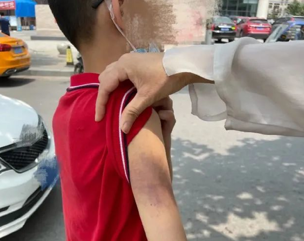全身多处淤青、脑震荡，11岁男孩被辅导班老师殴打，警方已介入-第1张图片-大千世界