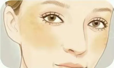 爱美女士看过来!注意这7点,轻松赶走蝴蝶斑
