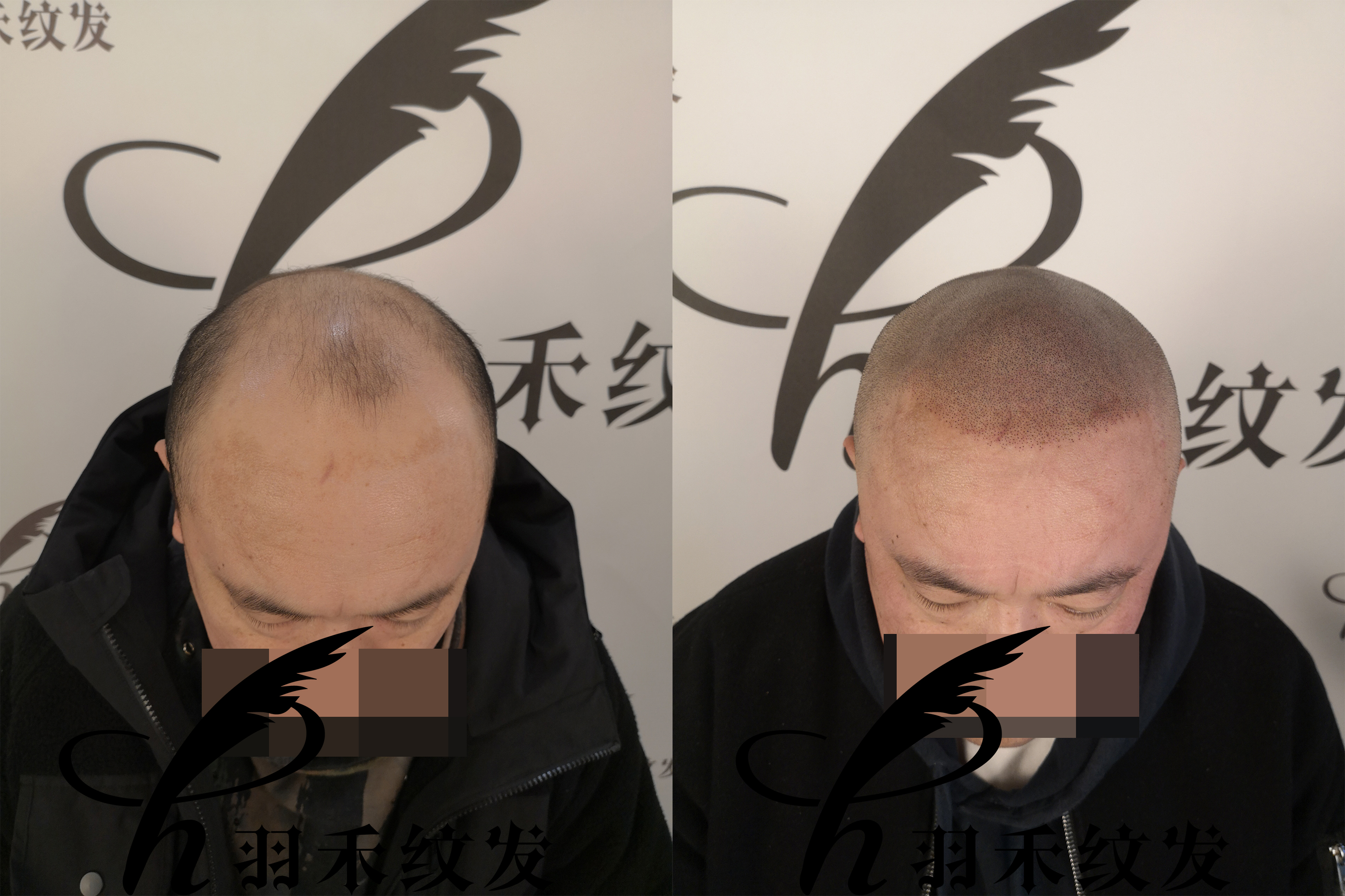 纹发后还能戴假发吗？