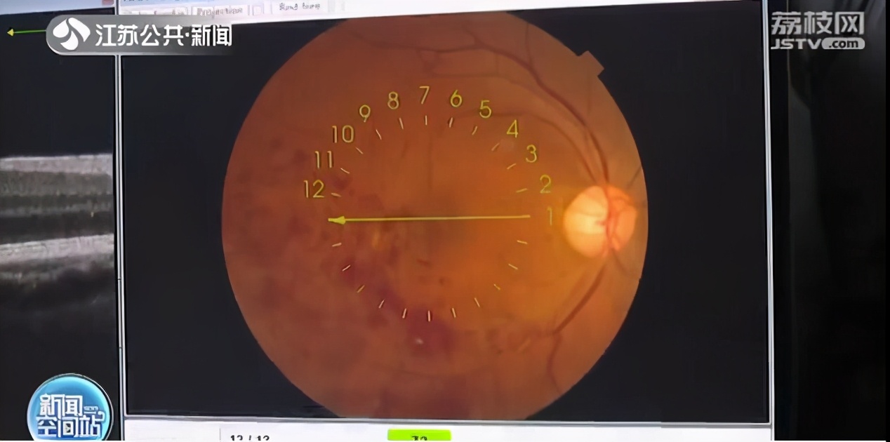 不控制血压眼睛也会“中风”！常州一市民因此差点失明